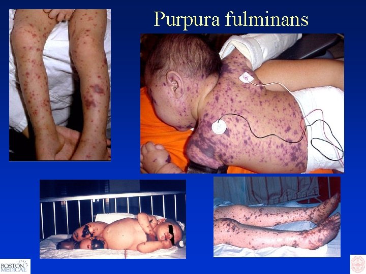 Purpura fulminans 