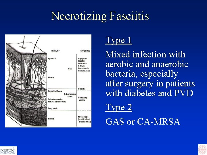 Necrotizing Fasciitis Type 1 Mixed infection with aerobic and anaerobic bacteria, especially after surgery