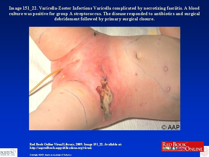 Image 151_22. Varicella-Zoster Infections Varicella complicated by necrotizing fasciitis. A blood culture was positive