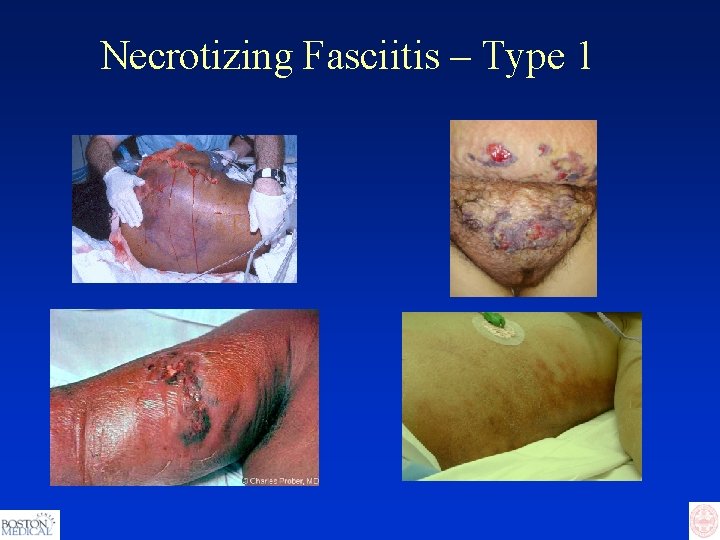 Necrotizing Fasciitis – Type 1 