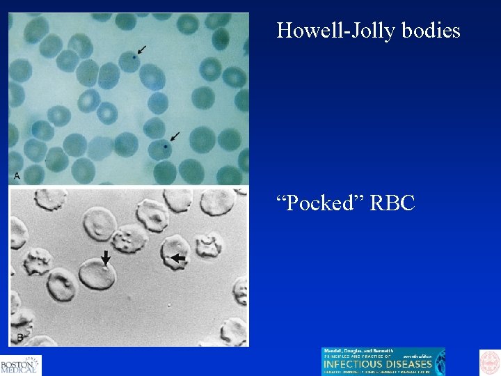 Howell-Jolly bodies “Pocked” RBC 