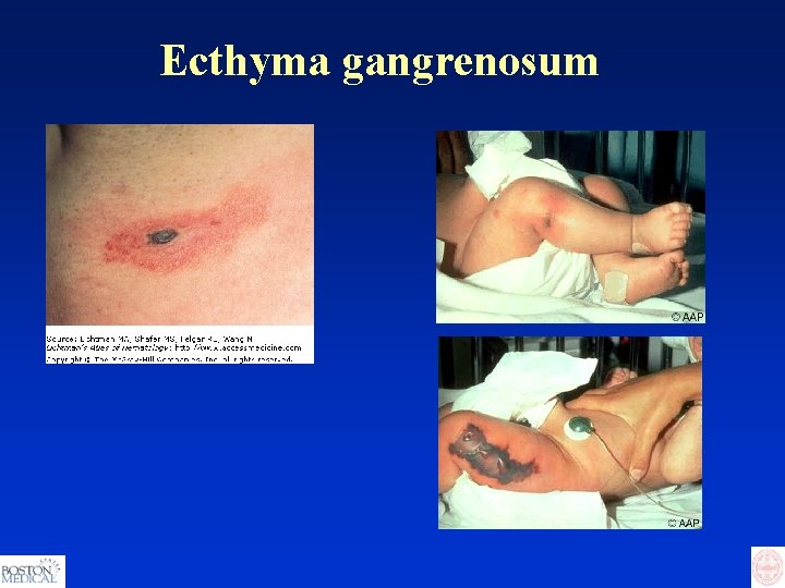Ecthyma gangrenosum 