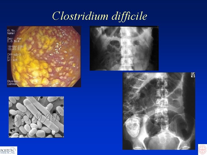 Clostridium difficile 