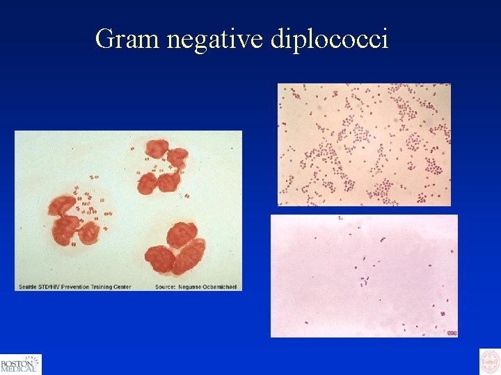 Gram negative diplococci 