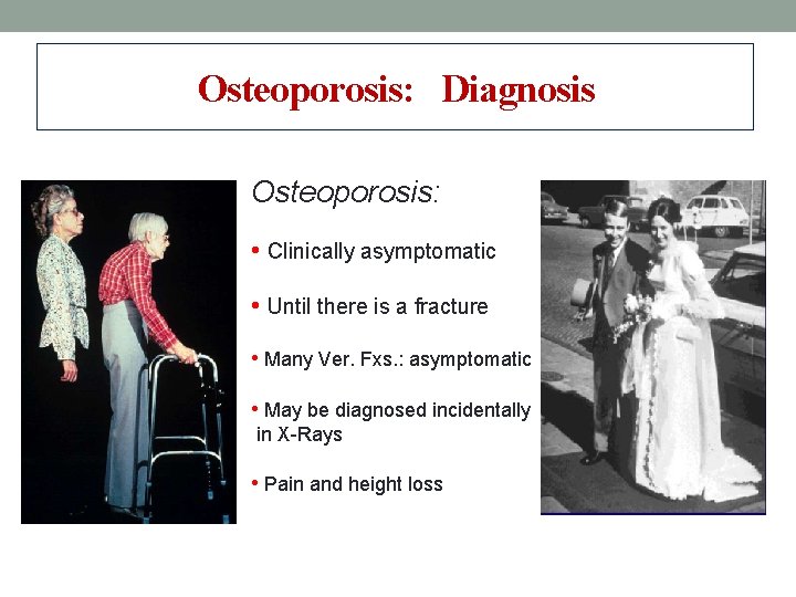 Osteoporosis: Diagnosis Osteoporosis: • Clinically asymptomatic • Until there is a fracture • Many