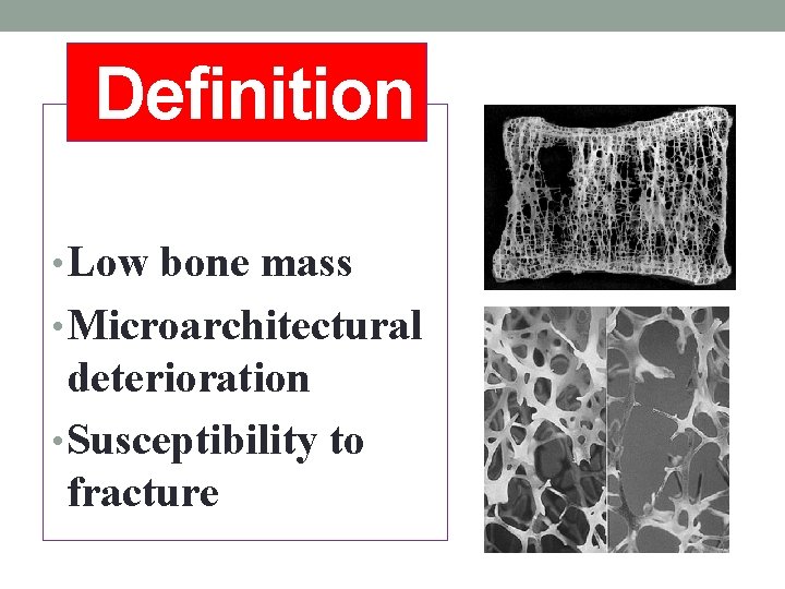 Definition • Low bone mass • Microarchitectural deterioration • Susceptibility to fracture 