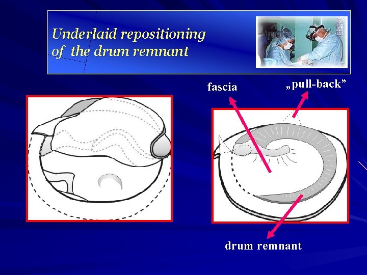 Underlaid repositioning of the drum remnant fascia „pull-back” drum remnant 