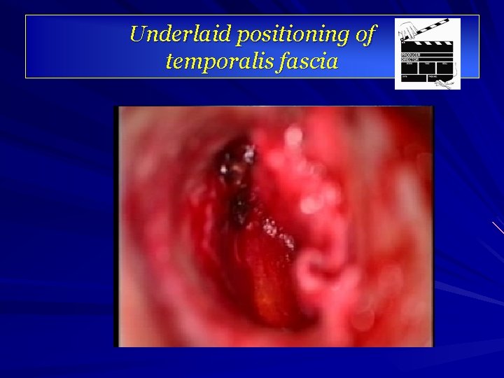 Underlaid positioning of temporalis fascia 