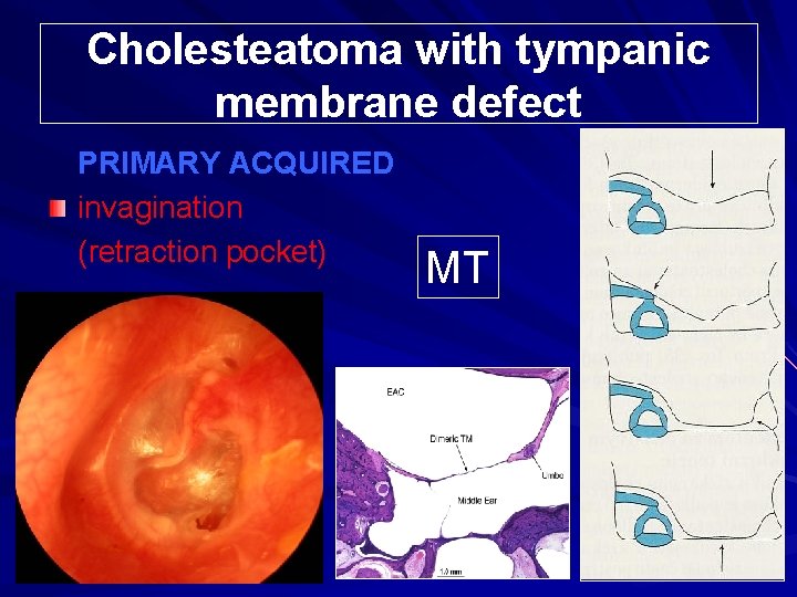 Cholesteatoma with tympanic membrane defect PRIMARY ACQUIRED invagination (retraction pocket) MT 