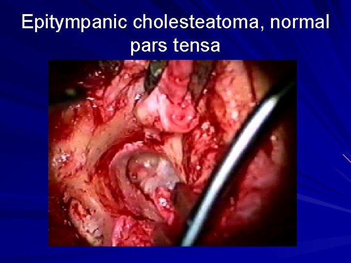 Epitympanic cholesteatoma, normal pars tensa 