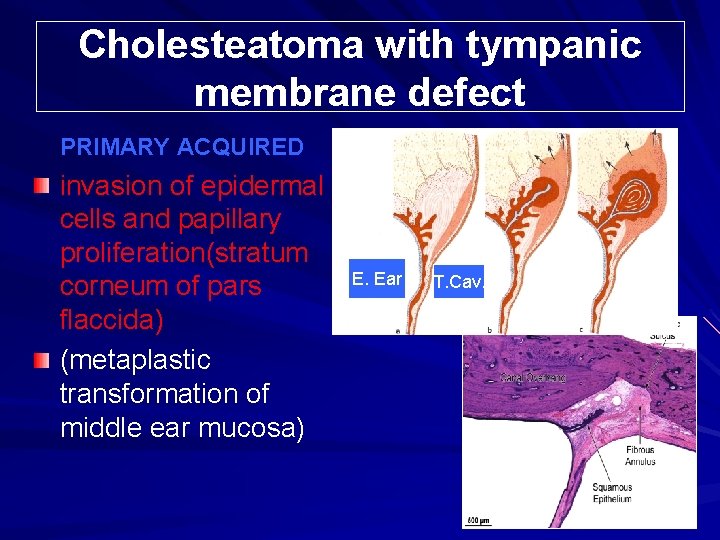 Cholesteatoma with tympanic membrane defect PRIMARY ACQUIRED invasion of epidermal cells and papillary proliferation(stratum