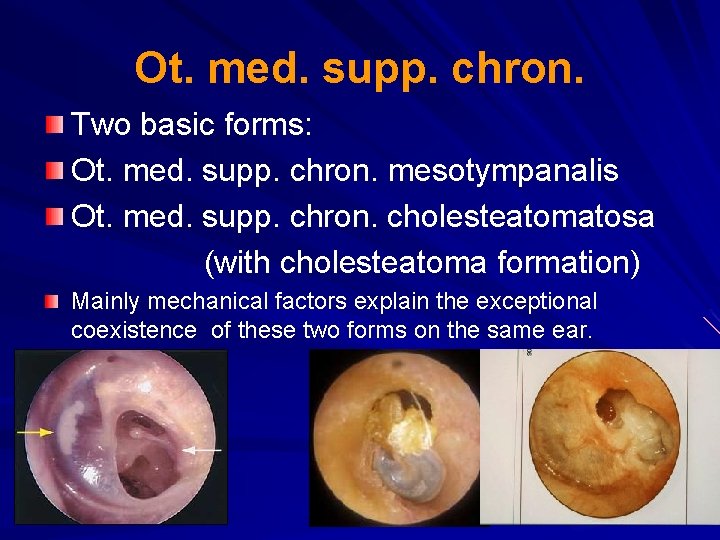 Ot. med. supp. chron. Two basic forms: Ot. med. supp. chron. mesotympanalis Ot. med.