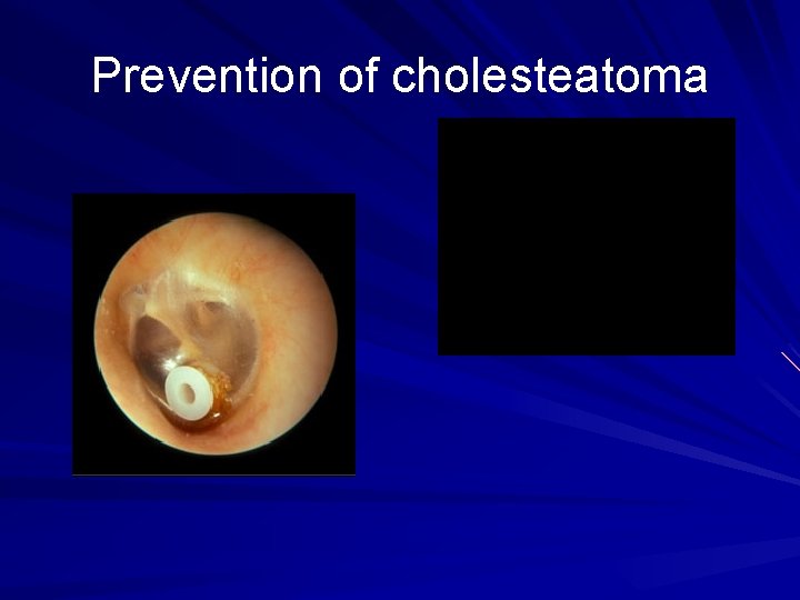 Prevention of cholesteatoma 