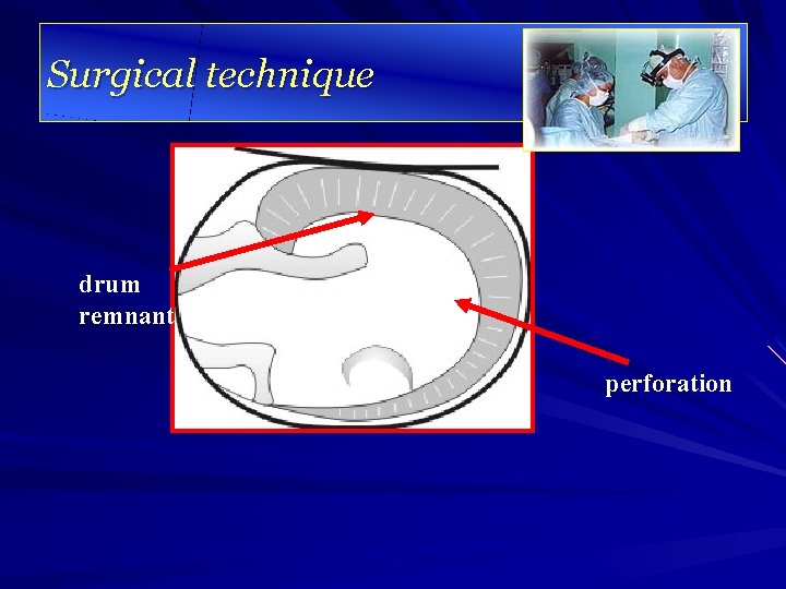 Surgical technique drum remnant perforation 