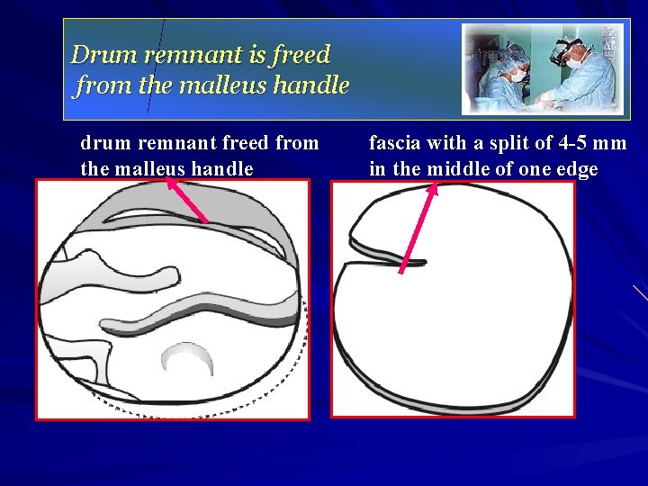 Drum remnant is freed from the malleus handle drum remnant freed from the malleus