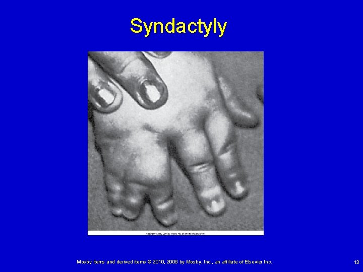 Syndactyly Mosby items and derived items © 2010, 2006 by Mosby, Inc. , an