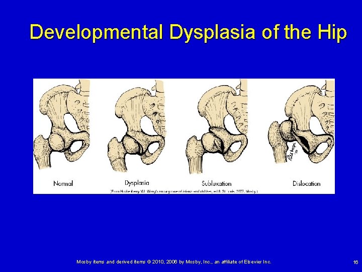 Developmental Dysplasia of the Hip Mosby items and derived items © 2010, 2006 by