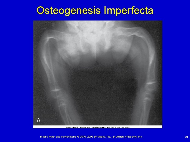 Osteogenesis Imperfecta Mosby items and derived items © 2010, 2006 by Mosby, Inc. ,