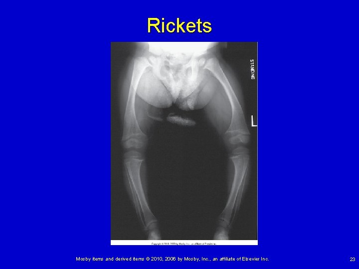 Rickets Mosby items and derived items © 2010, 2006 by Mosby, Inc. , an