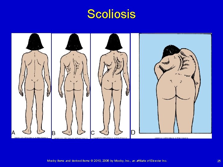 Scoliosis Mosby items and derived items © 2010, 2006 by Mosby, Inc. , an