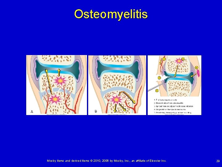 Osteomyelitis Mosby items and derived items © 2010, 2006 by Mosby, Inc. , an