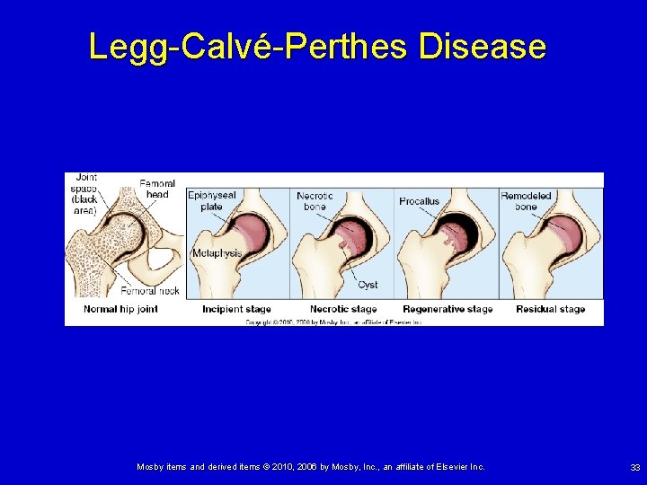 Legg-Calvé-Perthes Disease Mosby items and derived items © 2010, 2006 by Mosby, Inc. ,