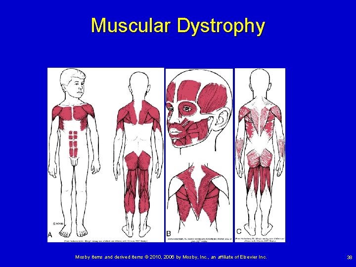 Muscular Dystrophy Mosby items and derived items © 2010, 2006 by Mosby, Inc. ,