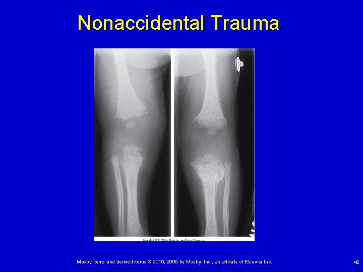 Nonaccidental Trauma Mosby items and derived items © 2010, 2006 by Mosby, Inc. ,