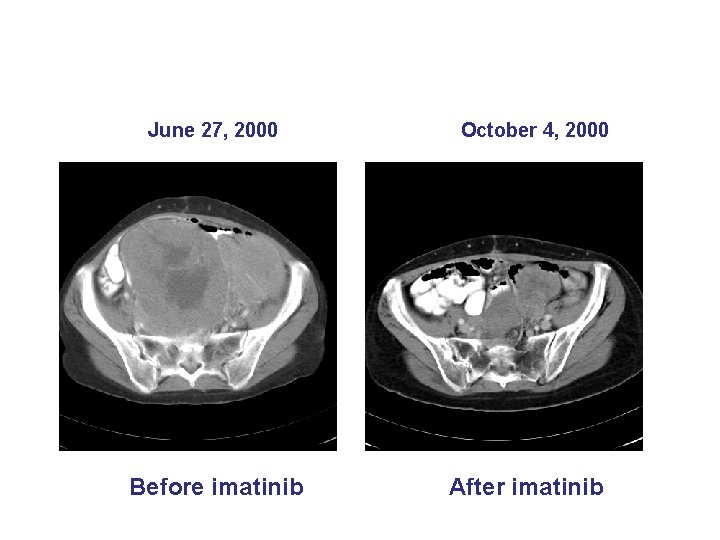 June 27, 2000 Before imatinib October 4, 2000 After imatinib 