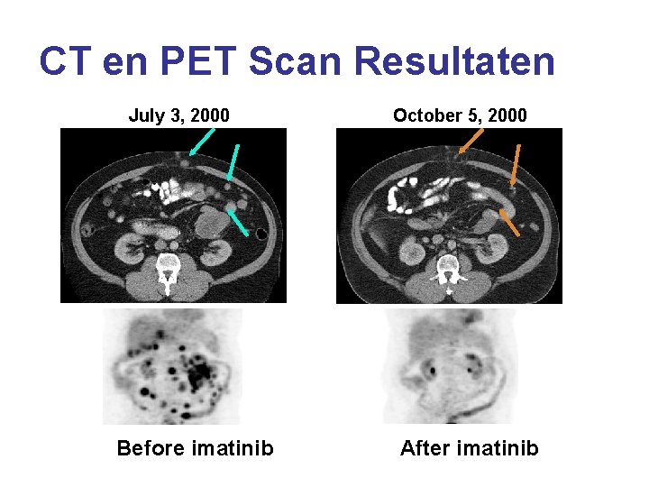 CT en PET Scan Resultaten July 3, 2000 Before imatinib October 5, 2000 After