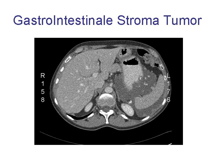 Gastro. Intestinale Stroma Tumor 