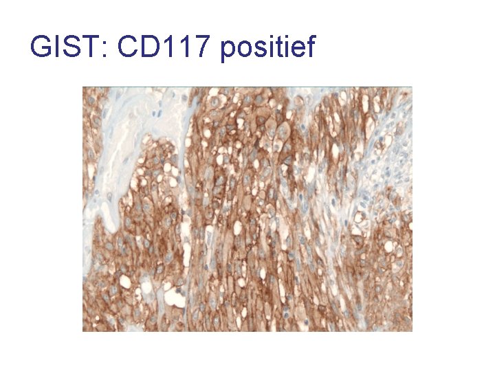 GIST: CD 117 positief 