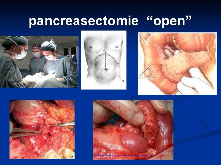 pancreasectomie “open” 
