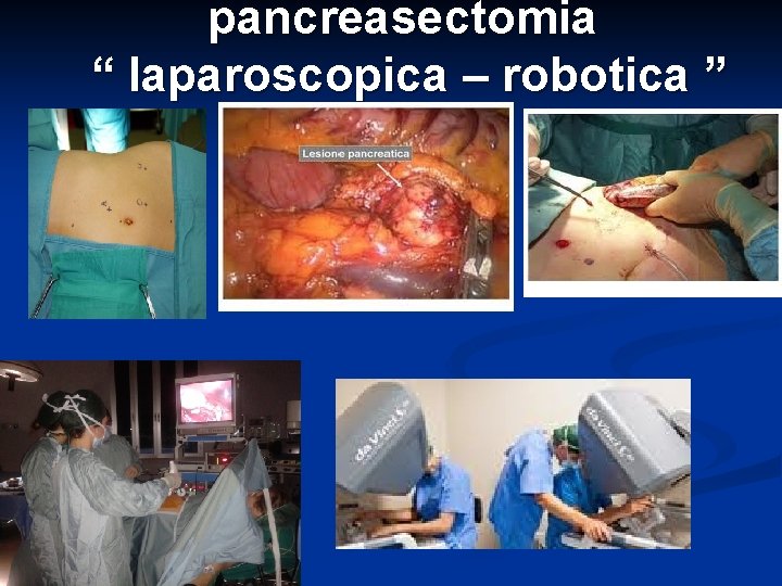 pancreasectomia “ laparoscopica – robotica ” 