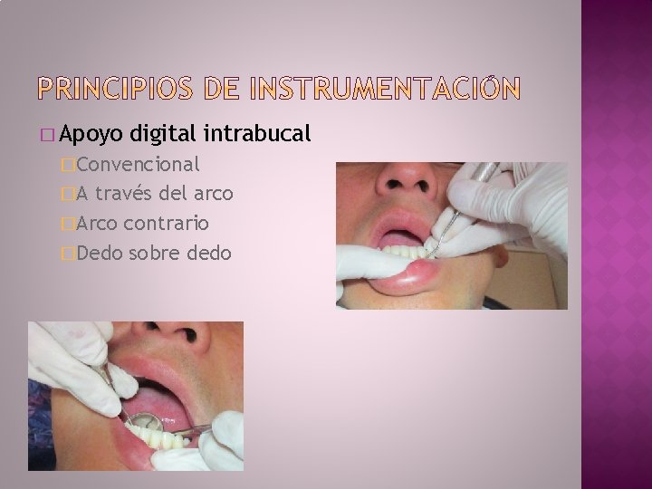 � Apoyo digital intrabucal �Convencional �A través del arco �Arco contrario �Dedo sobre dedo