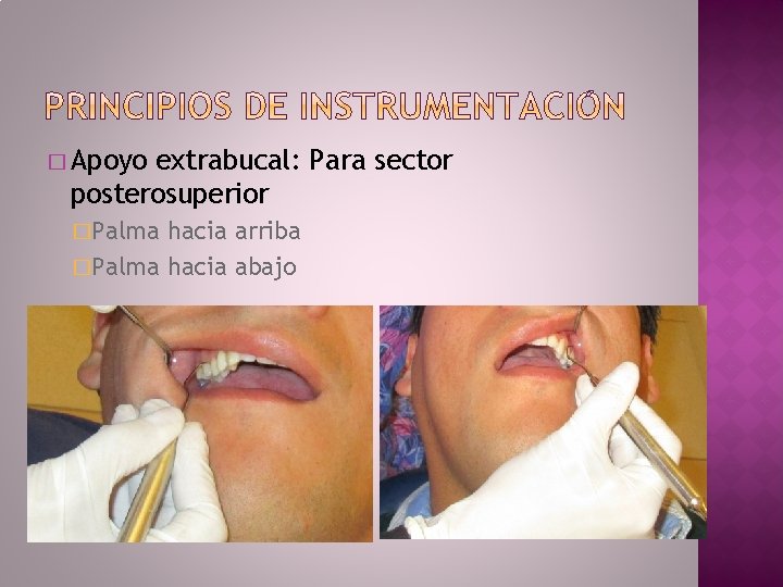 � Apoyo extrabucal: Para sector posterosuperior �Palma hacia arriba �Palma hacia abajo 