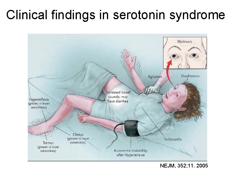 Clinical findings in serotonin syndrome NEJM, 352; 11. 2005 