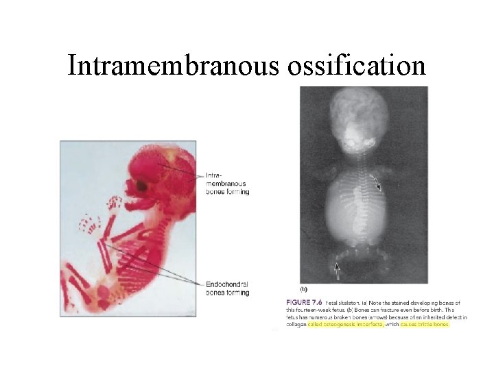 Intramembranous ossification 