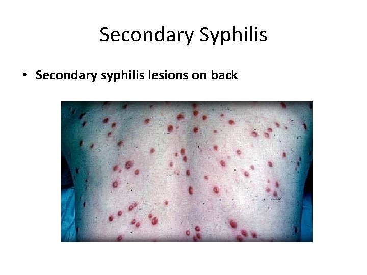 Secondary Syphilis • Secondary syphilis lesions on back 