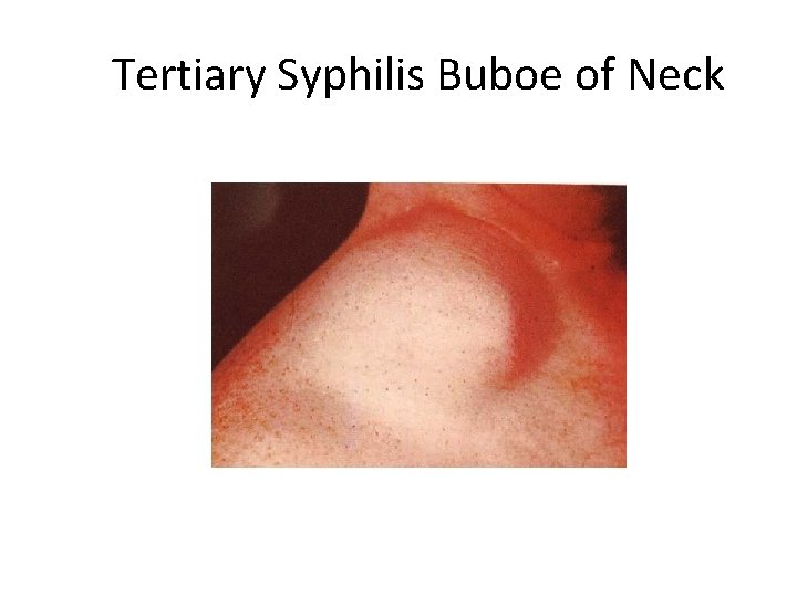 Tertiary Syphilis Buboe of Neck 