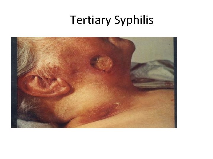 Tertiary Syphilis 