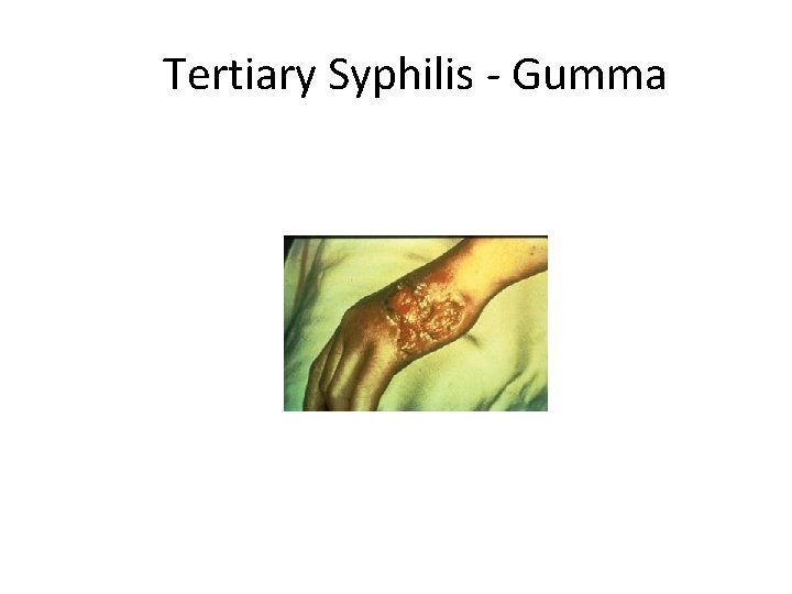 Tertiary Syphilis - Gumma 
