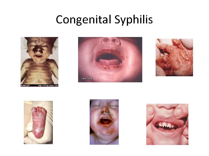 Congenital Syphilis 