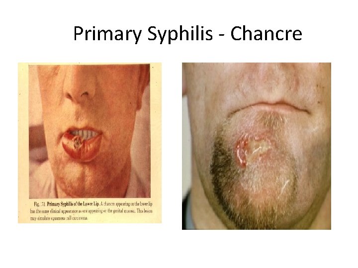 Primary Syphilis - Chancre 