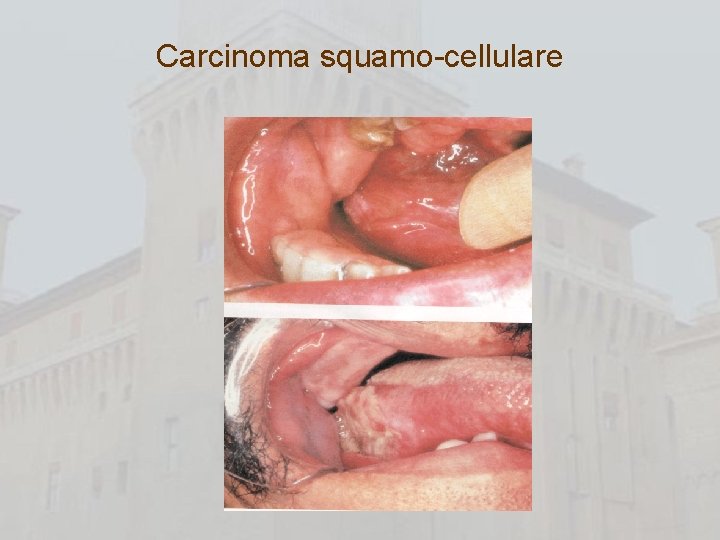 Carcinoma squamo-cellulare 