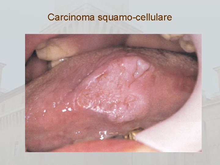 Carcinoma squamo-cellulare 