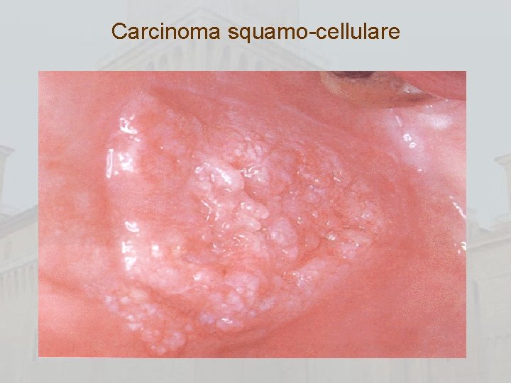 Carcinoma squamo-cellulare 