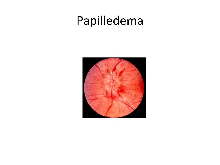 Papilledema 