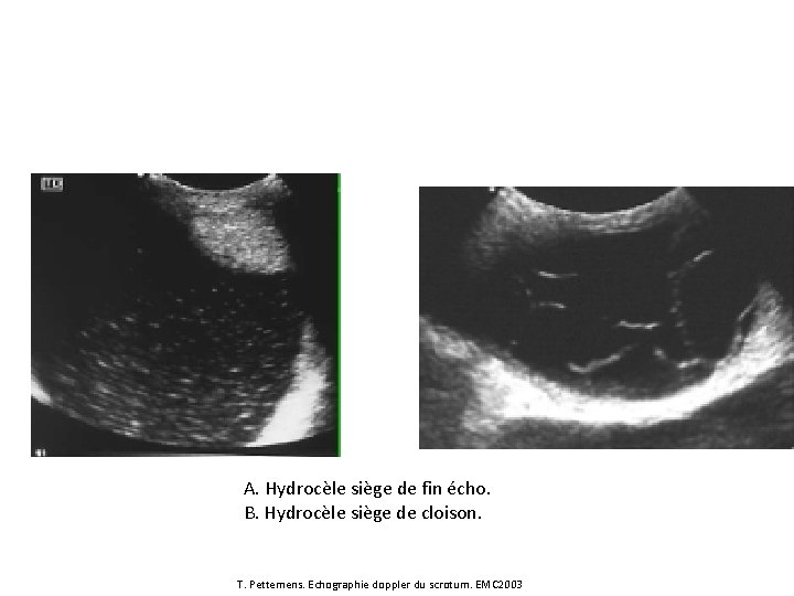 A B A. Hydrocèle siège de fin écho. B. Hydrocèle siège de cloison. T.