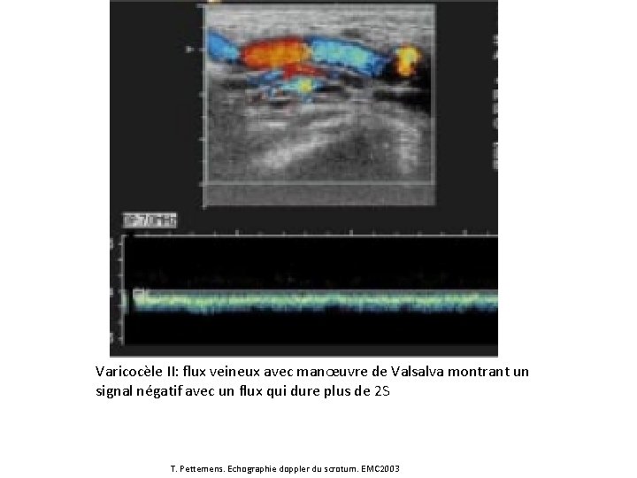 Varicocèle II: flux veineux avec manœuvre de Valsalva montrant un signal négatif avec un